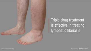 Tripledrug treatment is effective in treating lymphatic filariasis [upl. by Ree]