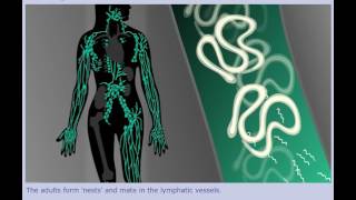 Lymphatic Filariasis Elephantiasis  Life Cycle [upl. by Meneau]