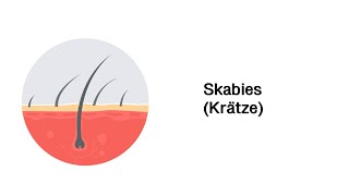 Skabies Krätze  Erkrankungen der Haut [upl. by Julis]