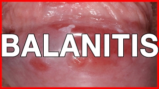 Balanitis Symptoms Causes Treatment and Prevention [upl. by Alansen818]