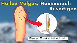 3 Übungen gegen Hallux Valgus Hammerzeh Ballenzeh  Die WAHRE Ursache amp Lösung [upl. by Durwood]